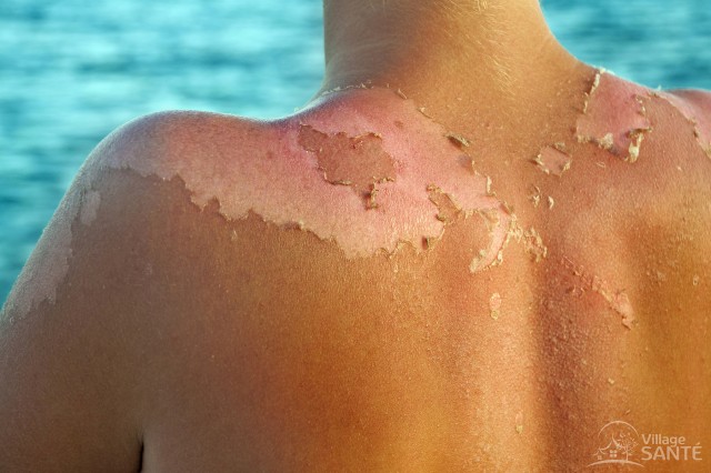 Le soleil : Une source de bonheurs à laquelle il faut faire attention ! 