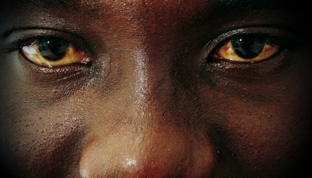 Œil rouge: Pourquoi?
