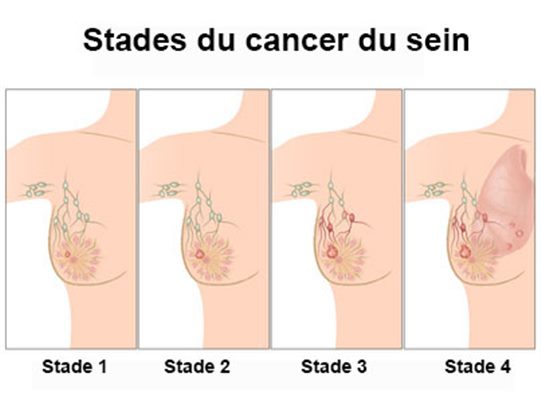 Breast Cancer Awareness: Saint-François de Sales Hospital Joins the Pink October Campaign