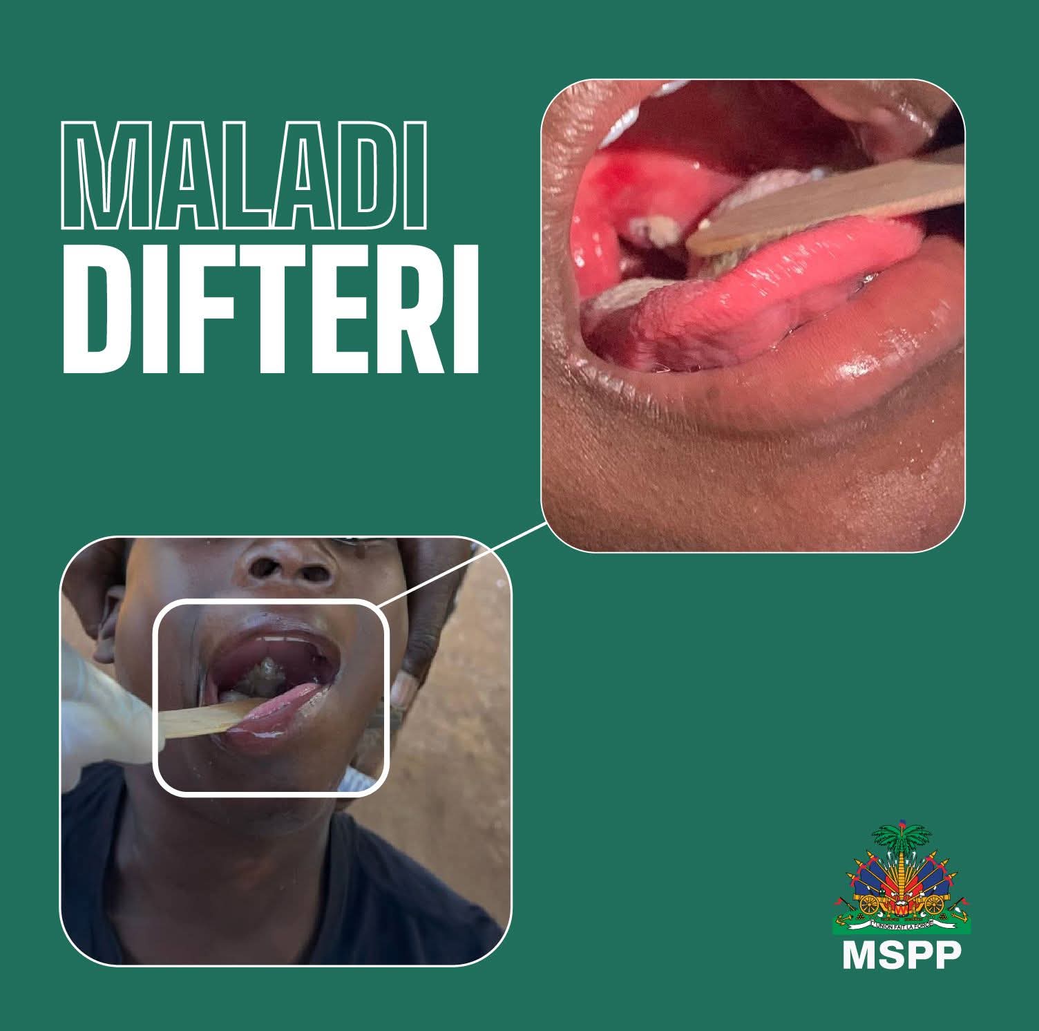 Hausse des cas de diphtérie en Haïti : le MSSP annonce une campagne de vaccination